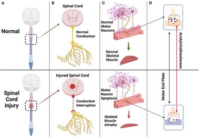 Mechanism of skeletal muscle atrophy after spinal cord injury: A narrative review